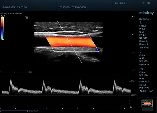 Mindray Resona 6 — Клинические изображения — фото 10