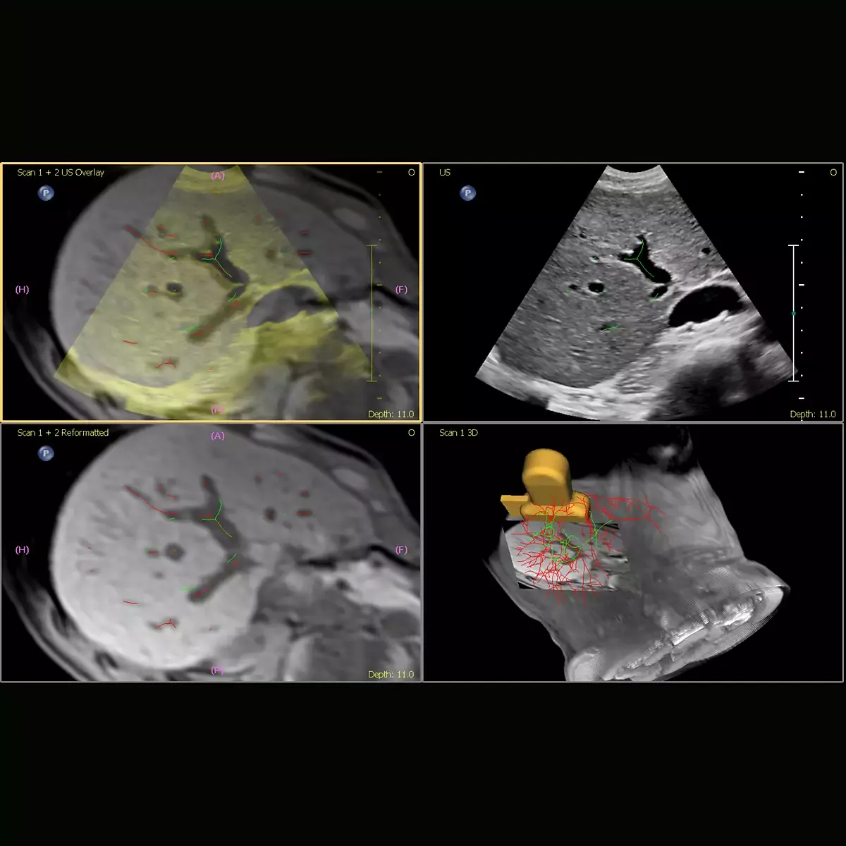 Philips EPIQ Elite — Anatomical Intelligence Ultrasound (AIUS)