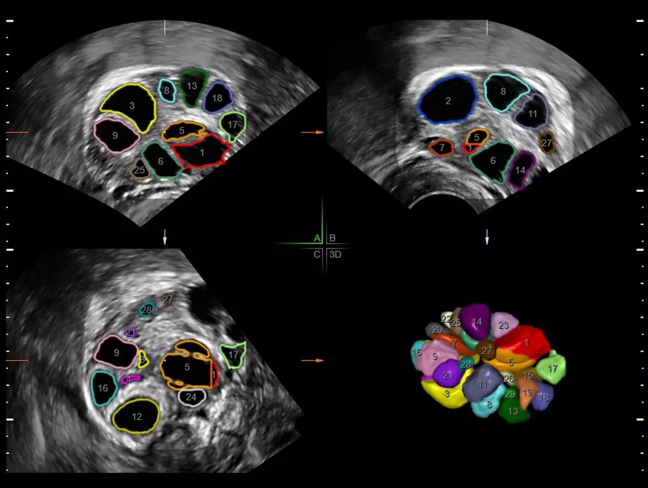 GE Voluson P8 — Sono-автоматизация: меньше нажатий в каждом исследовании — фото 3