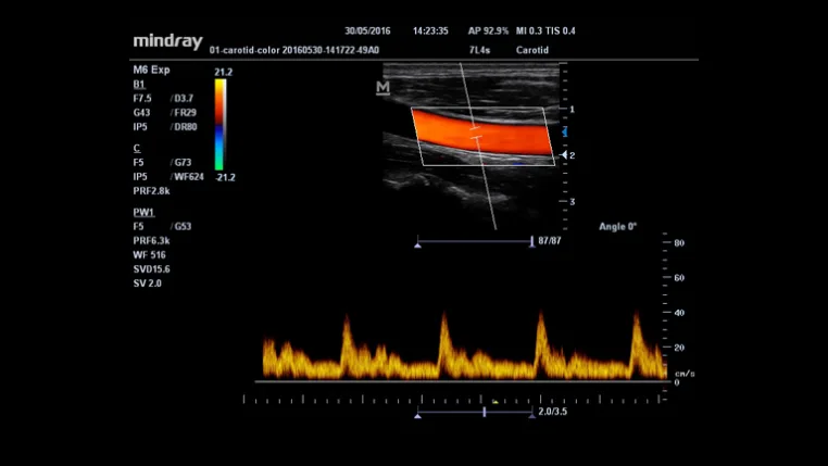 Mindray M6 — Клинические изображения — фото 8