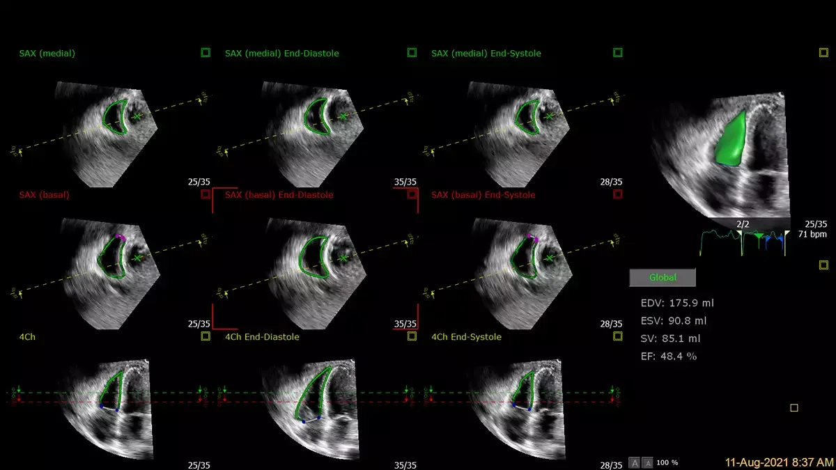 Philips EPIQ CVx — Клинические изображения EPIQ CVx — фото 2