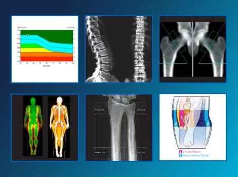 GE HealthCare Lunar iDXA — Не только кость: состав тела и метаболизм