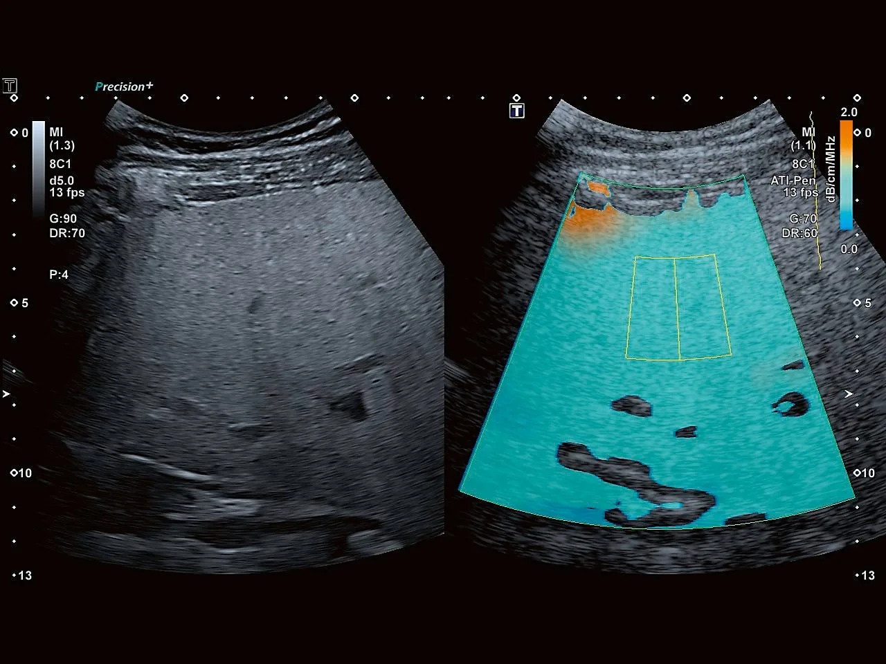 Canon Aplio a550 — Attenuation Imaging: оценка стеатоза печени