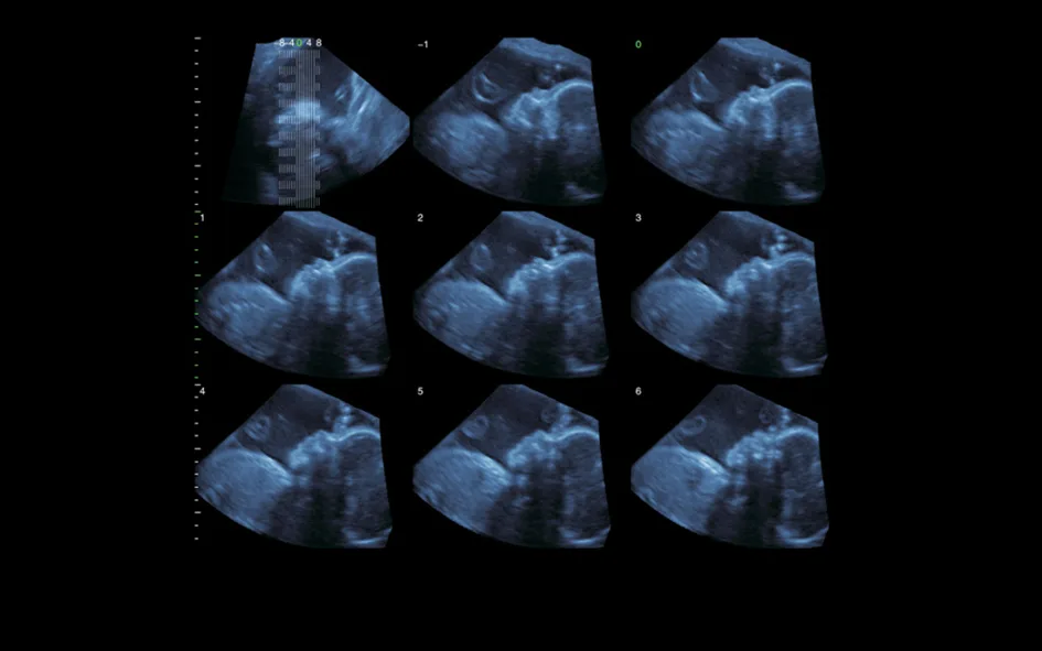 SIUI Apogee 5300 — 4D-сканирование: nSlice, Any Cut и Opti-4D