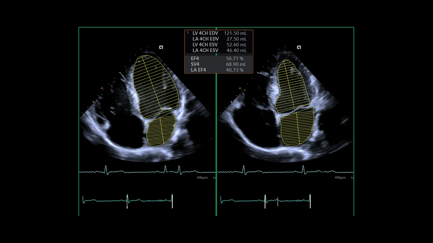 Siemens ACUSON Redwood — eSie Left Heart — левые отделы сердца