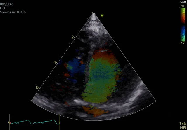 GE Vivid E90 — Blood Speckle Imaging: наглядная гемодинамика