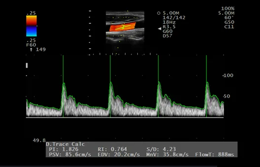Fujifilm Arietta 50 / 50LE — Doppler Auto Trace: измерение на лету