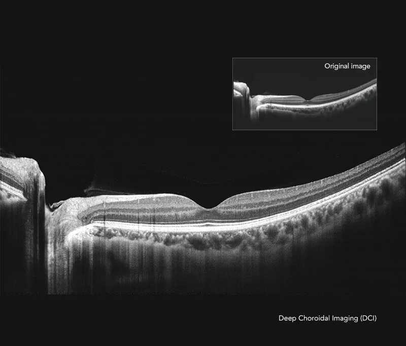 MOPTIM Mocean 3000 — Deep Choroidal Imaging: хориоидея под сетчаткой