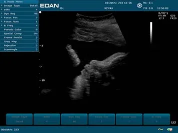 EDAN U2 Prime Edition — Экран системы и клинические примеры — фото 3