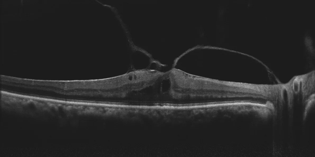 MOPTIM Mocean 3000 — Патологии сетчатки на снимках Mocean 3000 — фото 2